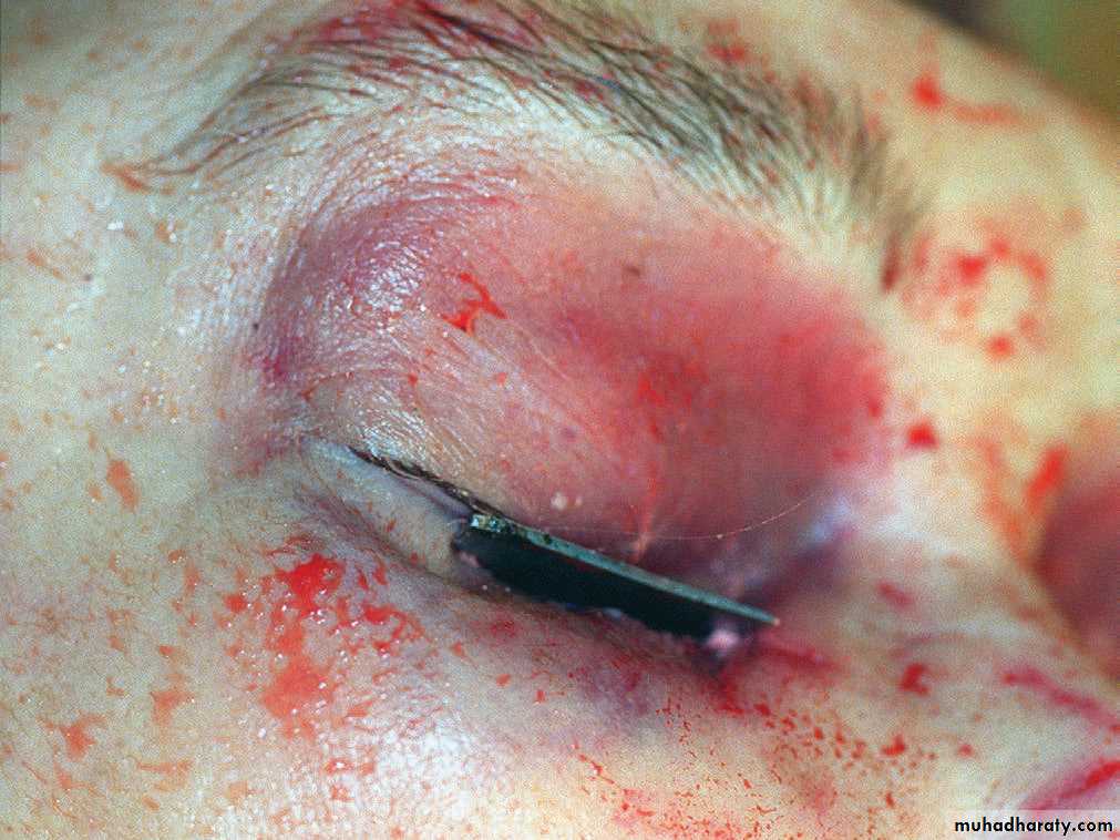 Wounds