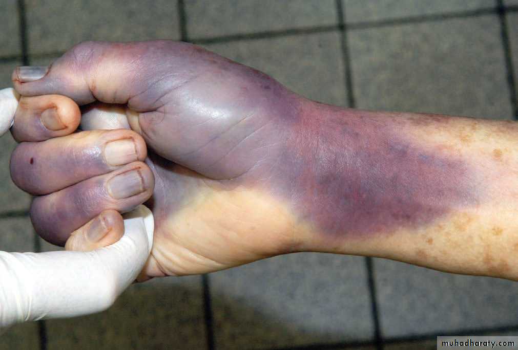 Wounds