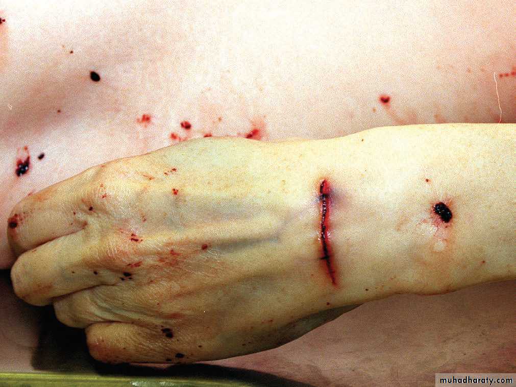 Wounds