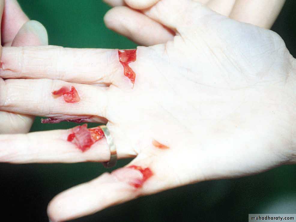 Wounds