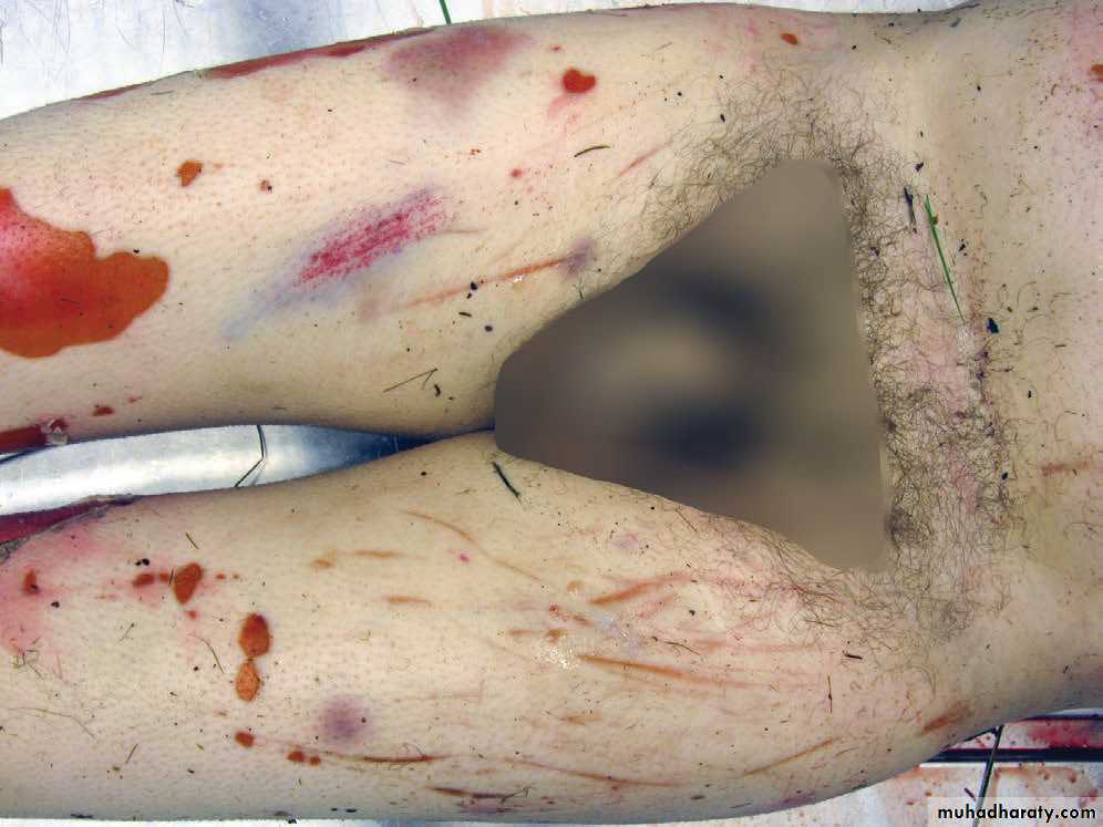 Wounds