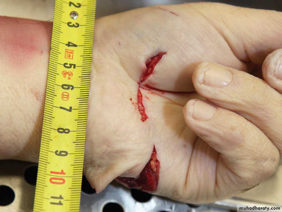 Wounds