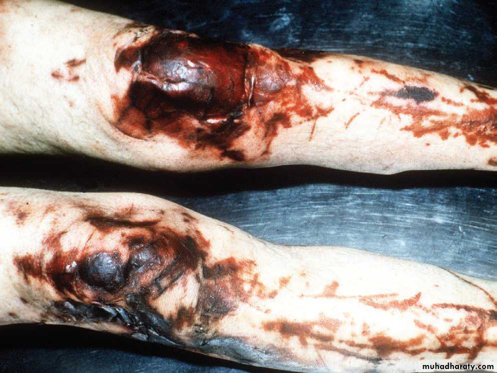 Wounds