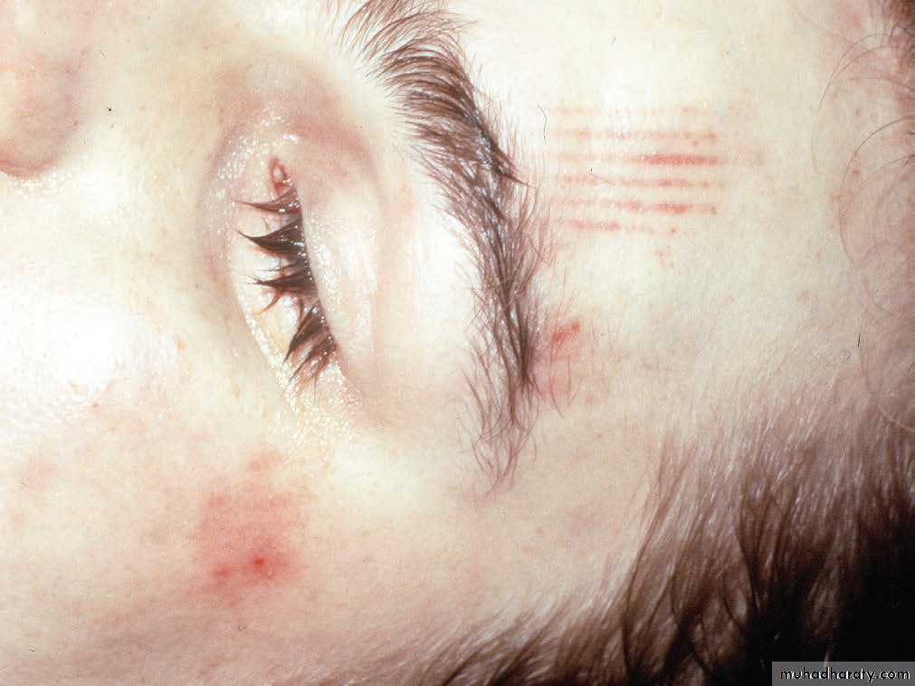 Wounds