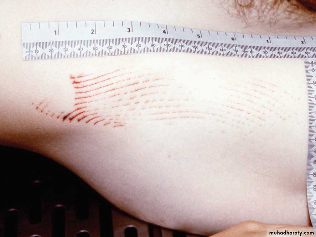 Wounds