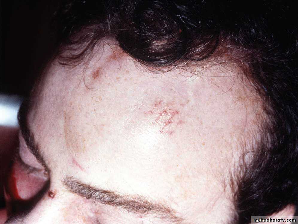 Wounds