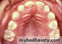 Morphology of Deciduous teeth