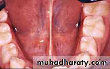 Morphology of Deciduous teeth
