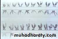 Morphology of Deciduous teeth