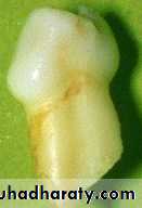 Morphology of Deciduous teeth