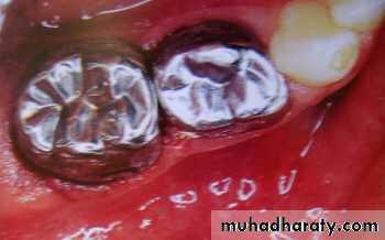 Morphology of Deciduous teeth