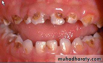 Morphology of Deciduous teeth