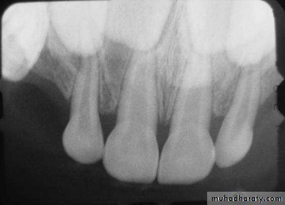 Morphology of Deciduous teeth