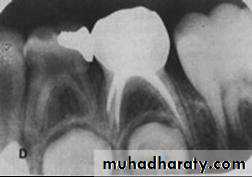 Morphology of Deciduous teeth