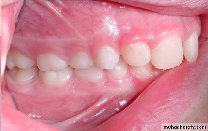Morphology of Deciduous teeth