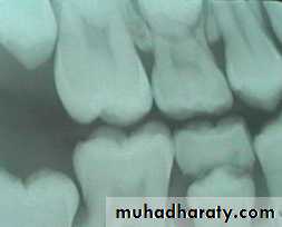 Morphology of Deciduous teeth