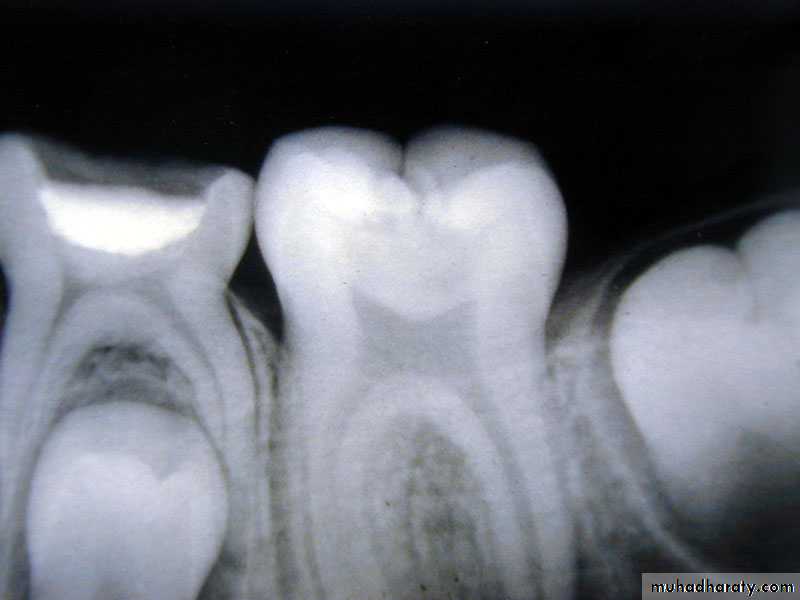 Morphology of Deciduous teeth