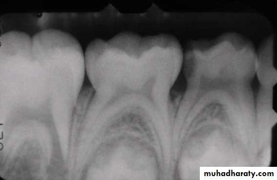 Morphology of Deciduous teeth