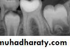 Morphology of Deciduous teeth