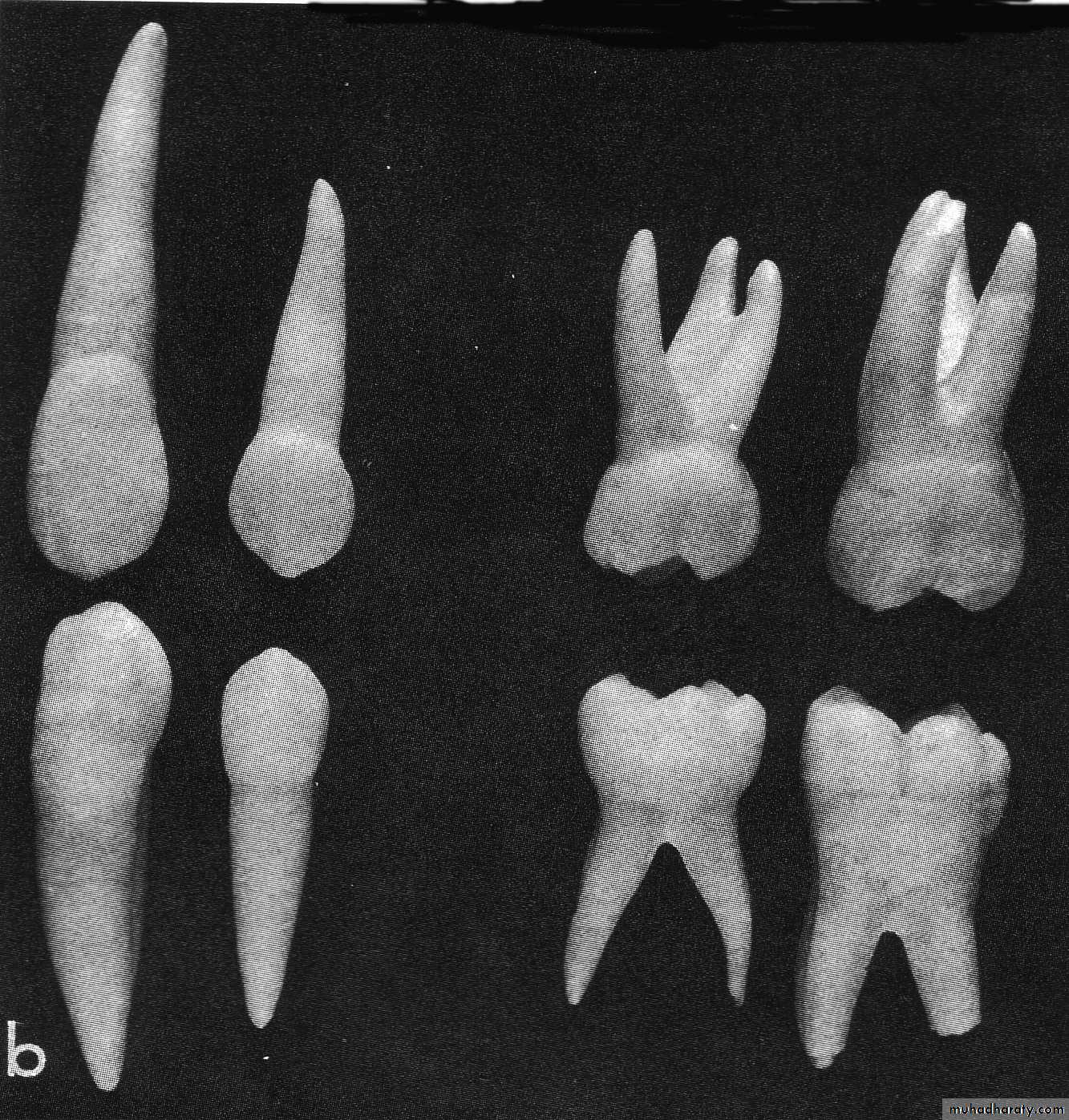 Morphology of Deciduous teeth