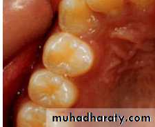 Morphology of Deciduous teeth