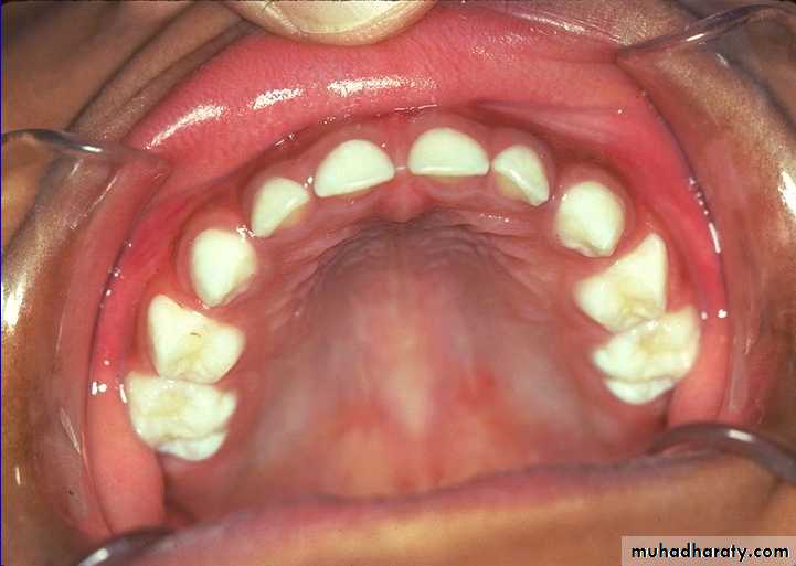 Morphology of Deciduous teeth