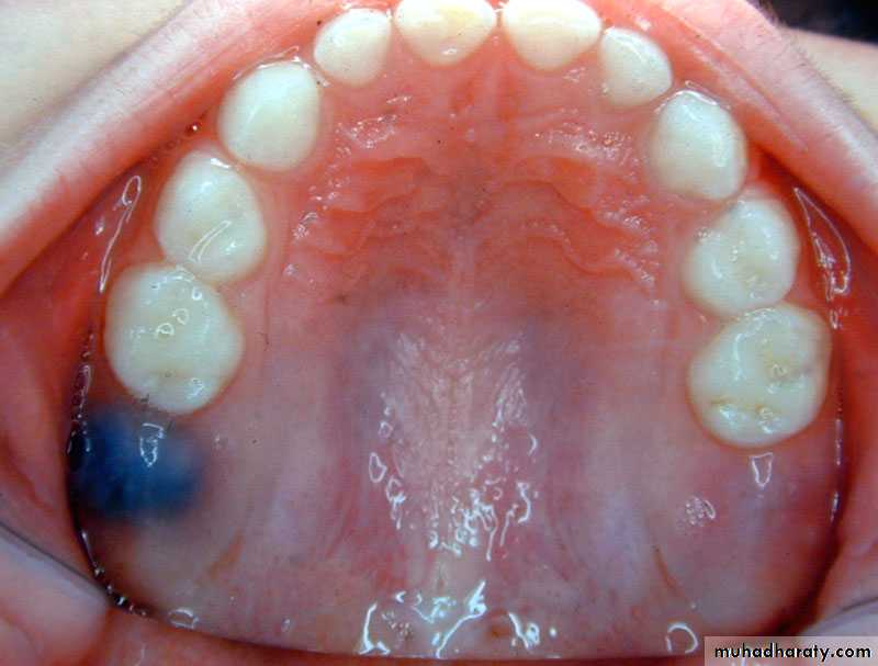 Morphology of Deciduous teeth