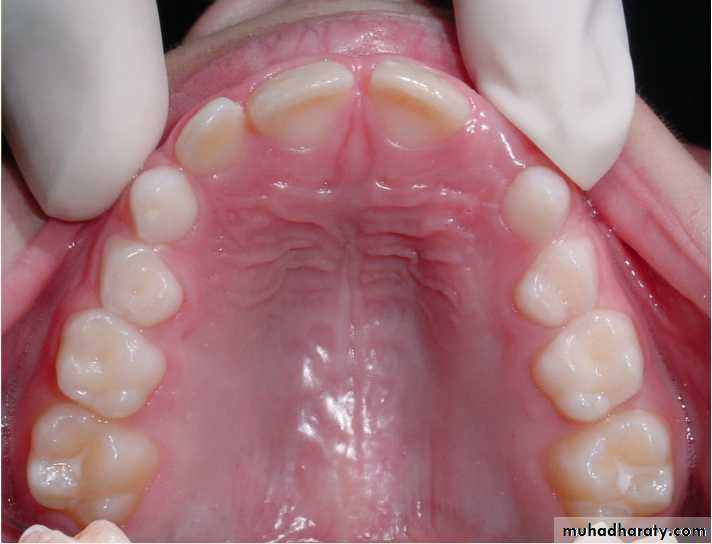 Morphology of Deciduous teeth