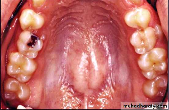 Morphology of Deciduous teeth