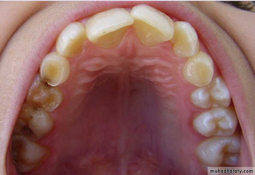 Morphology of Deciduous teeth