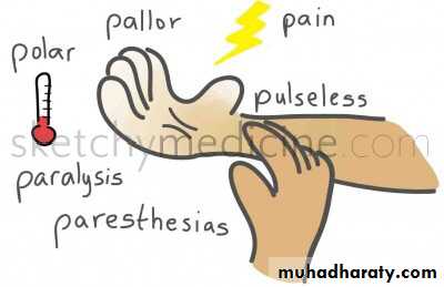 Acute Limb Ischemia