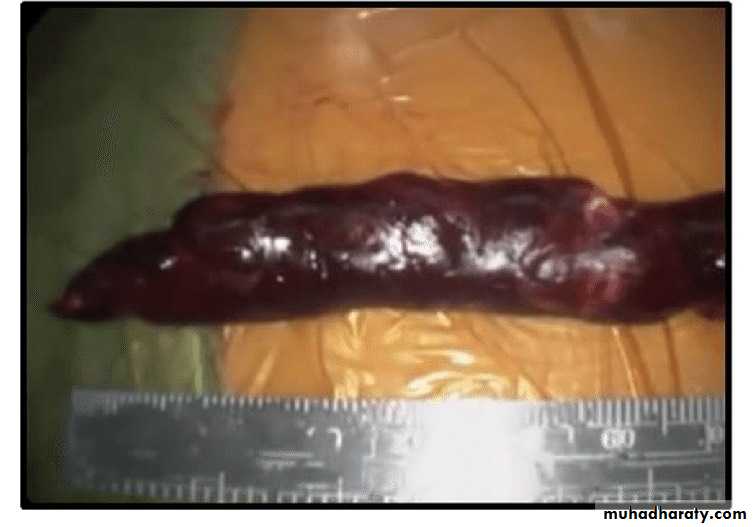Acute Limb Ischemia