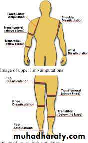 Acute Limb Ischemia