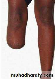 Acute Limb Ischemia