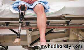 Acute Limb Ischemia