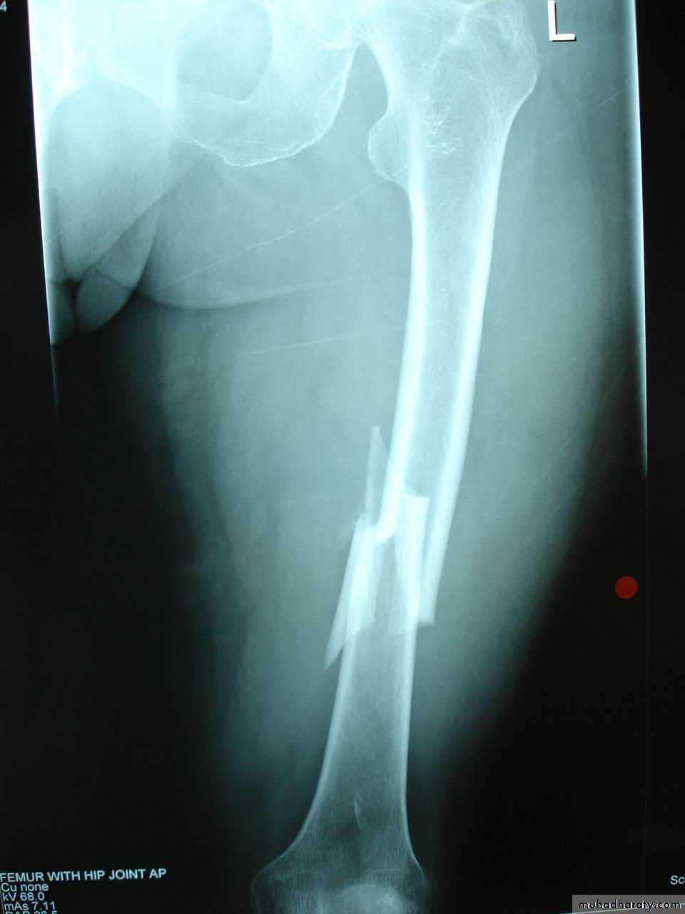 Introduction to Fractures