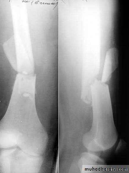Introduction to Fractures