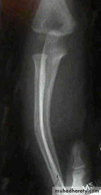 Introduction to Fractures