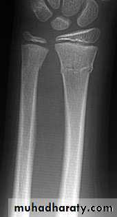 Introduction to Fractures