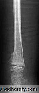 Introduction to Fractures