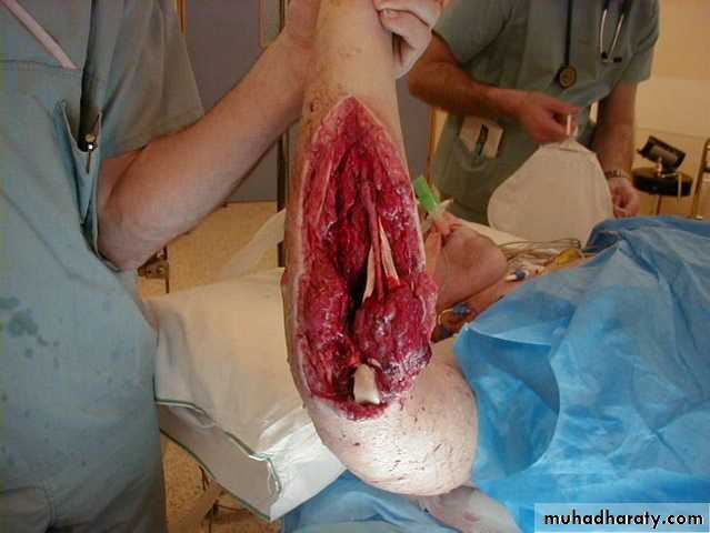 Introduction to Fractures