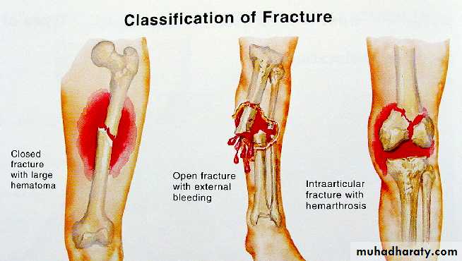 Introduction to Fractures