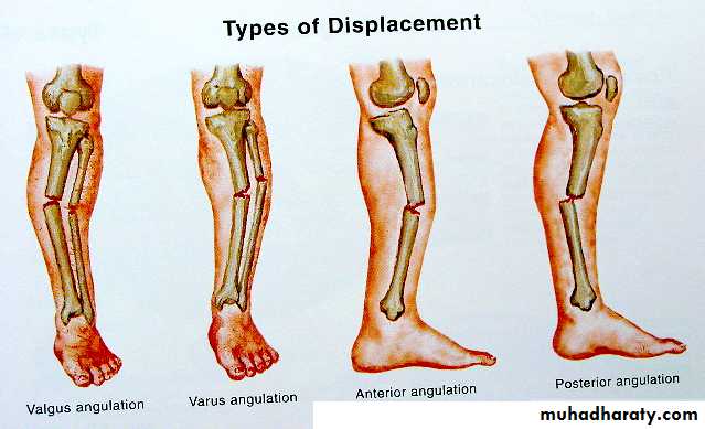 Introduction to Fractures
