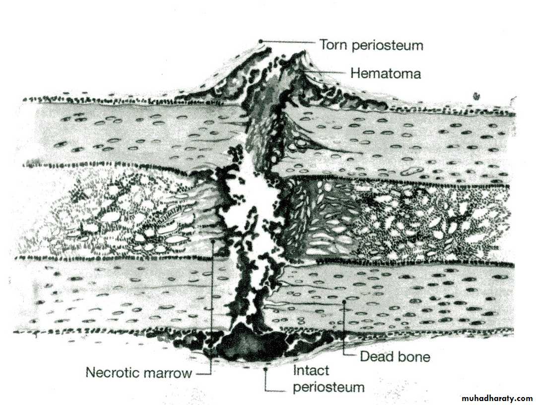 Introduction to Fractures