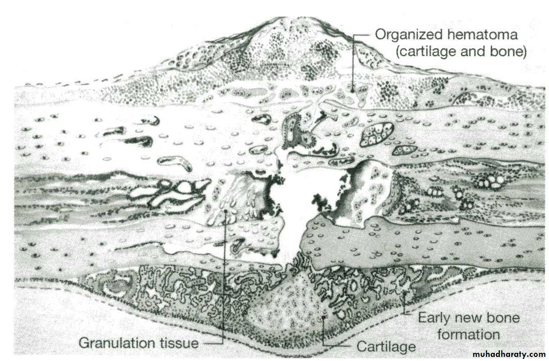 Introduction to Fractures