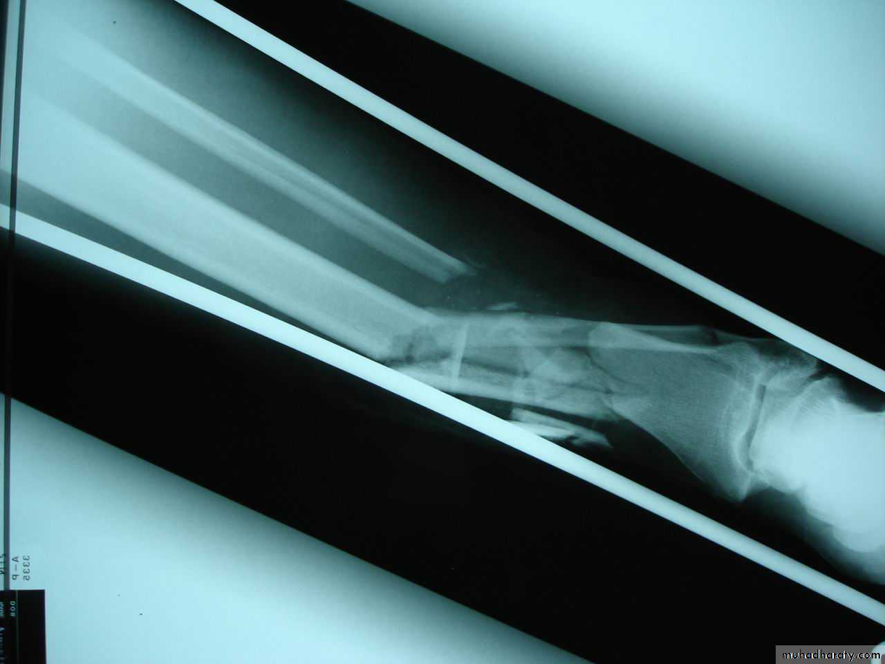 Introduction to Fractures