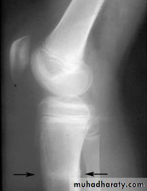 Introduction to Fractures