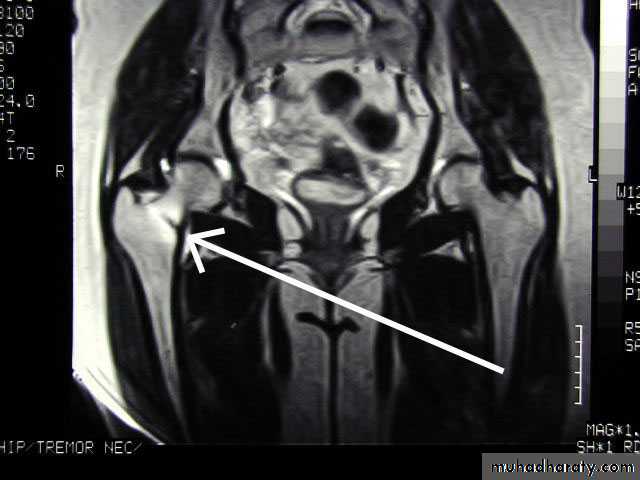 Introduction to Fractures