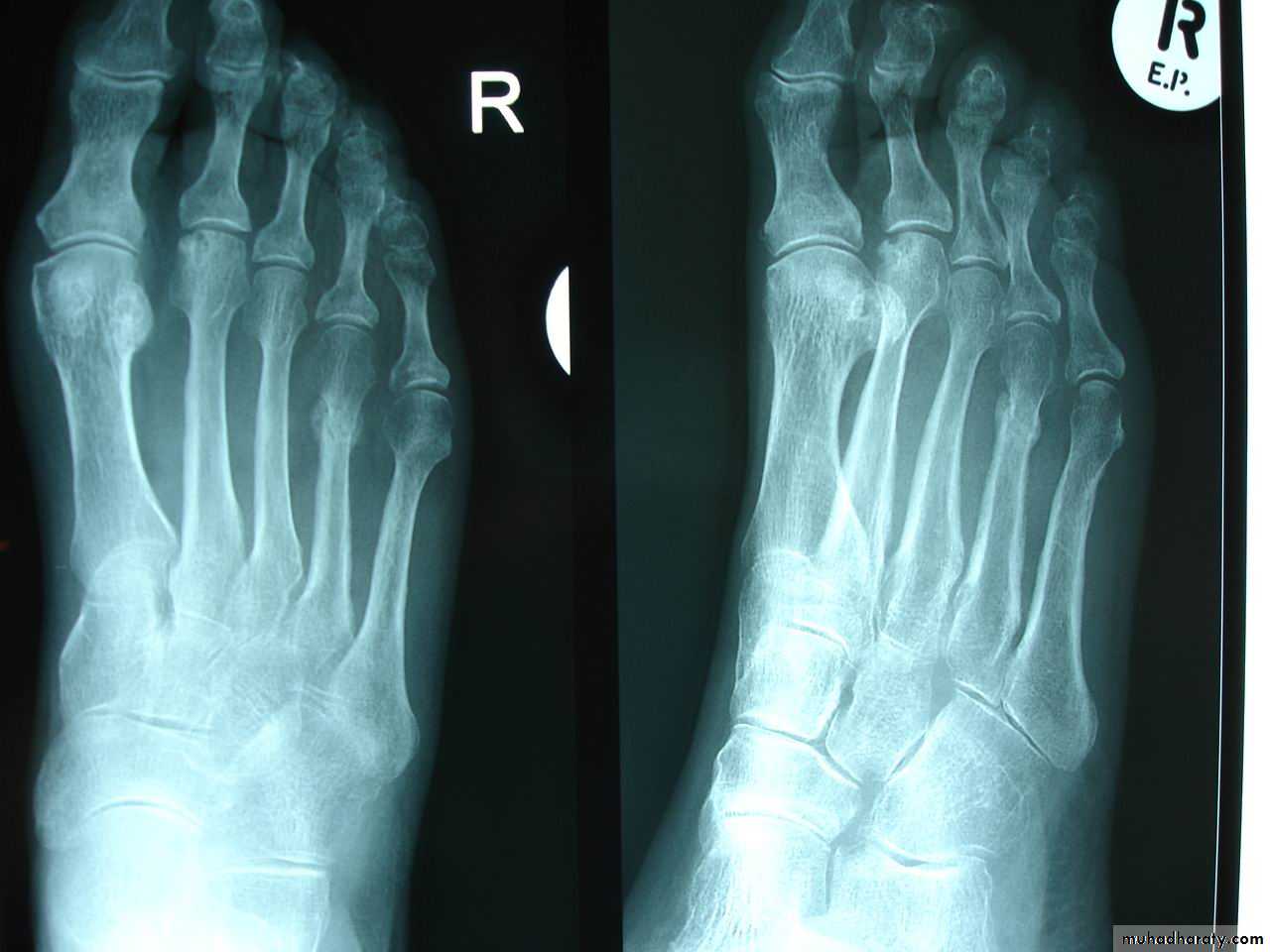 Introduction to Fractures