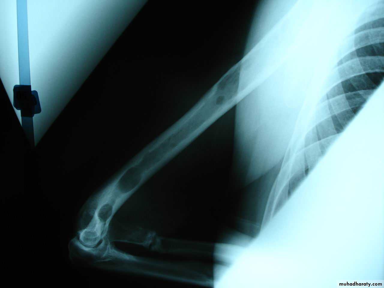 Introduction to Fractures